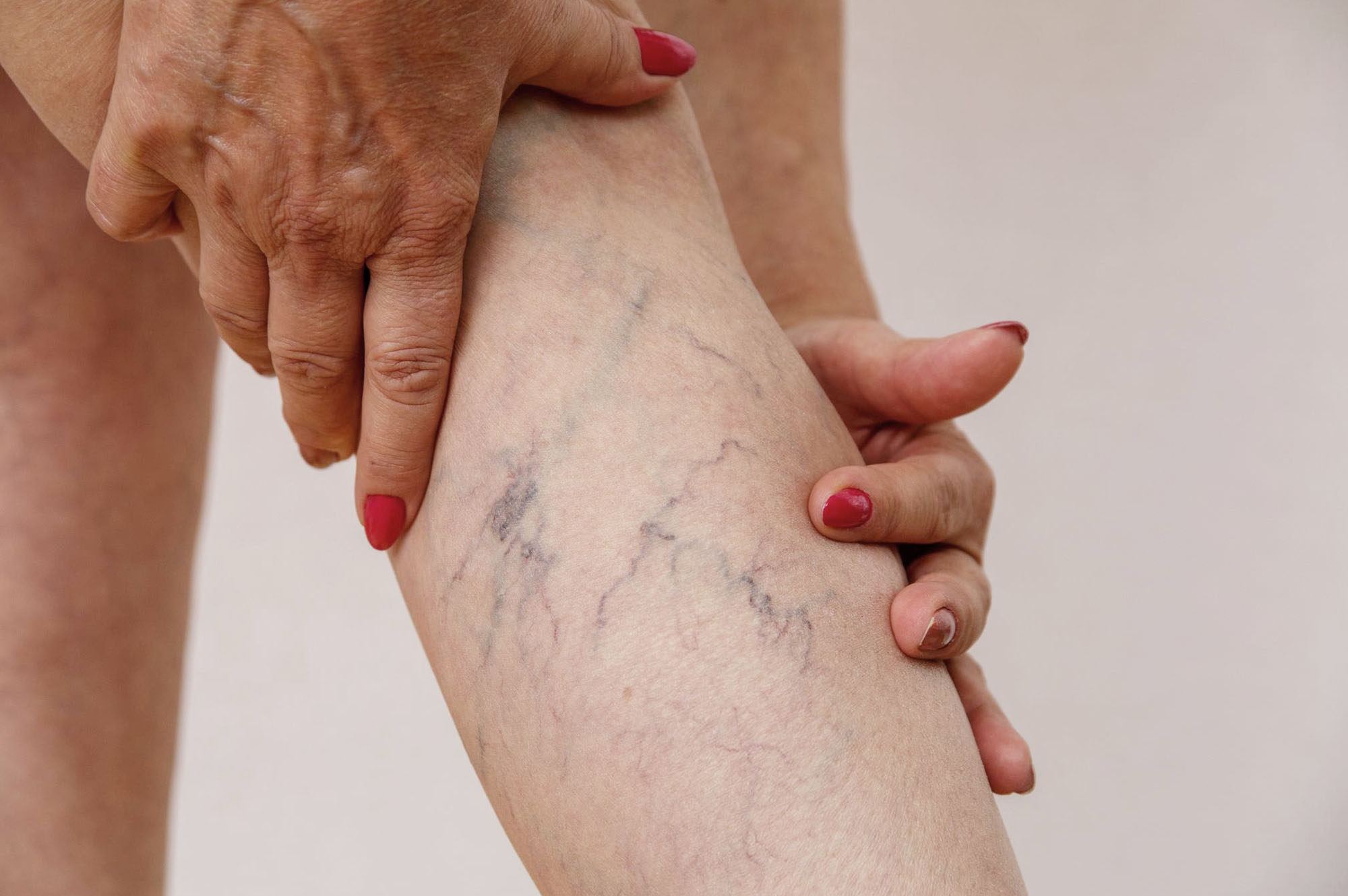 Атеросклероз нижних конечностей: причины, симптомы и лечение